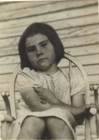 Sarah Jacob's at age 8 yrs old, she burnt her arm with the iron that her mother told her not to touch. (1941)